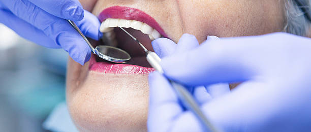 Best Chipped Tooth Repair Near Me  in Bluffton, OH